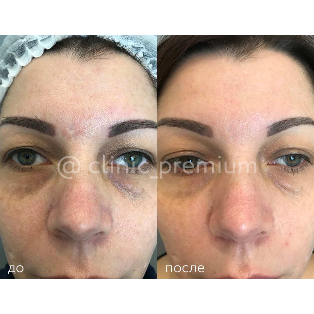 Сферогель в косметологии для глаз до и после фото