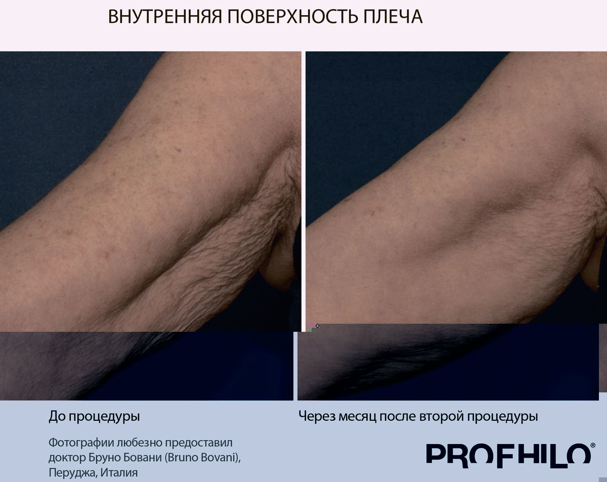 Профайло фото до и после верхняя поверхность плеча